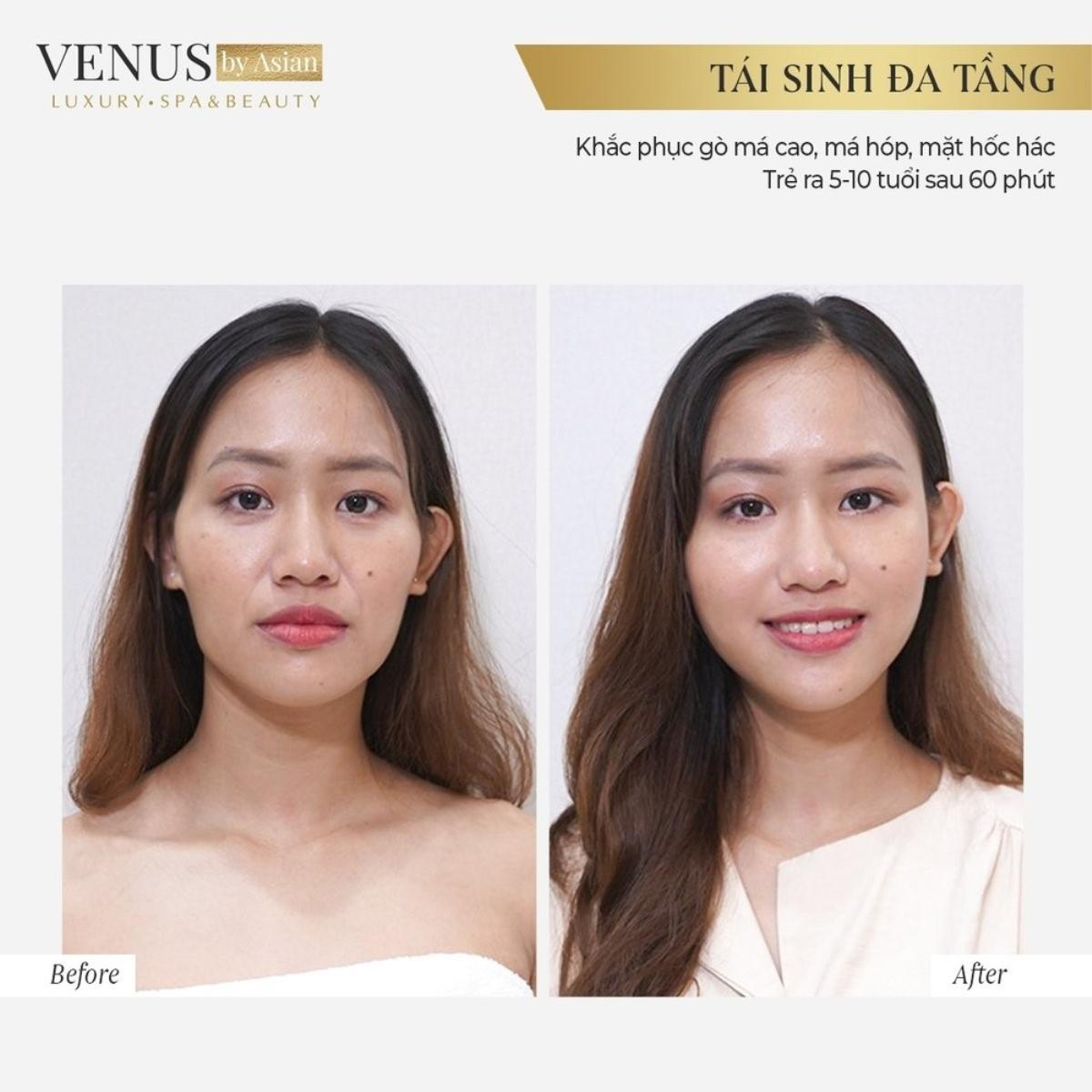 Phòng khám chuyên khoa phẫu thuật tạo hình thẩm mỹ Venus by Asian nơi Tâm - Tầm - Tài hội tụ Ảnh 3