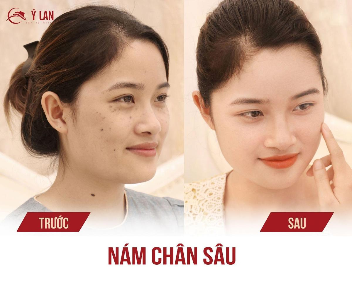 Thẩm mỹ viện Ý Lan địa chỉ trị nám uy tín hàng đầu tại Hà Nội Ảnh 3