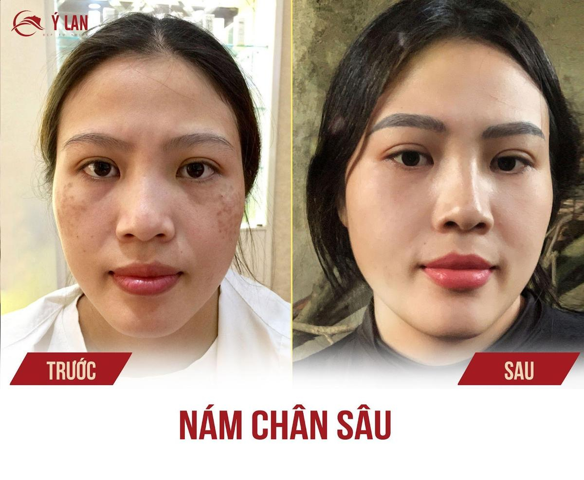 Thẩm mỹ viện Ý Lan địa chỉ trị nám uy tín hàng đầu tại Hà Nội Ảnh 4