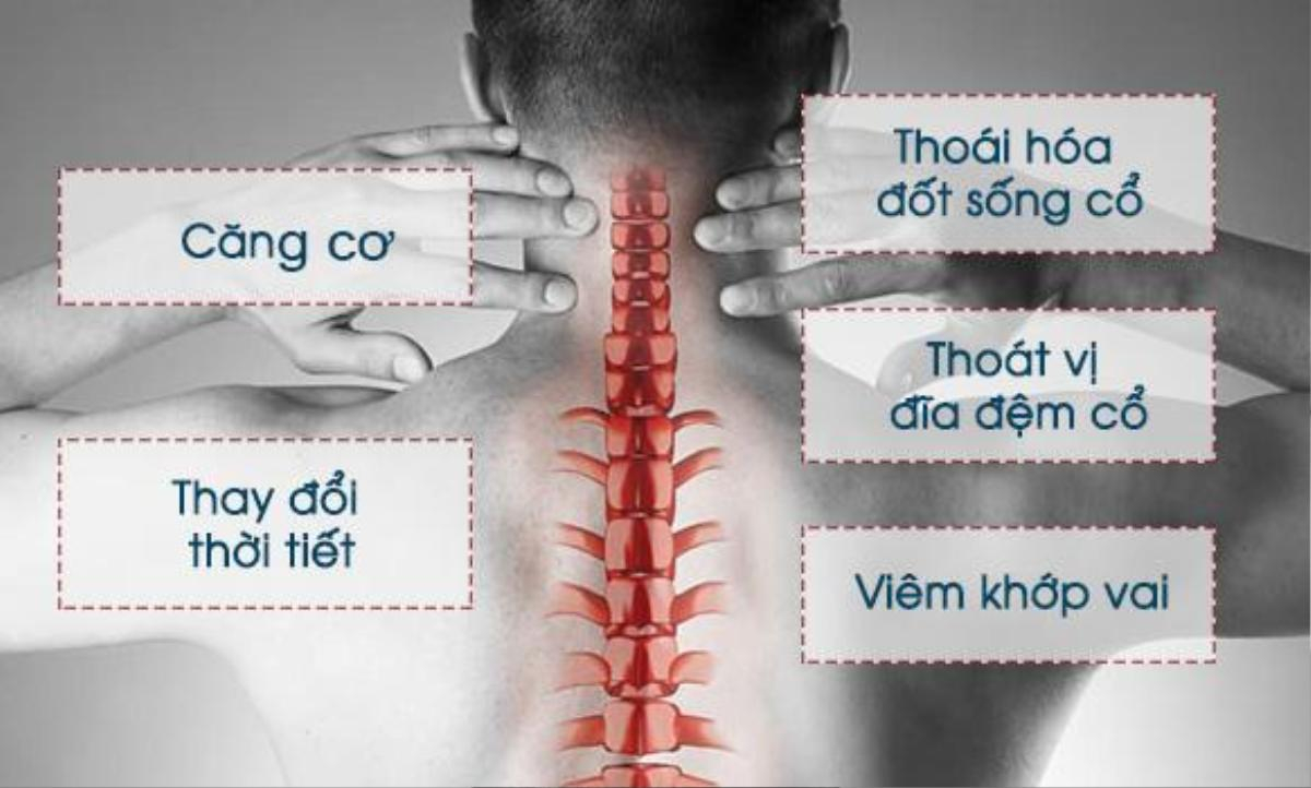 Chăm Sóc Sức Khỏe Việt - Đau cổ vai gáy cảnh báo nhiều bệnh nguy hiểm và xử trí đúng cách! Ảnh 2