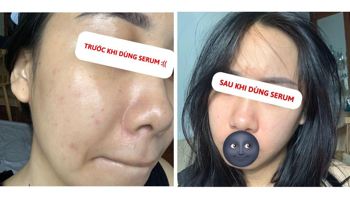 Hội chị em mê làm đẹp trầm trồ vì serum mỹ phẩm Việt đánh bay mụn dậy thì chỉ sau 2 tuần Ảnh 1