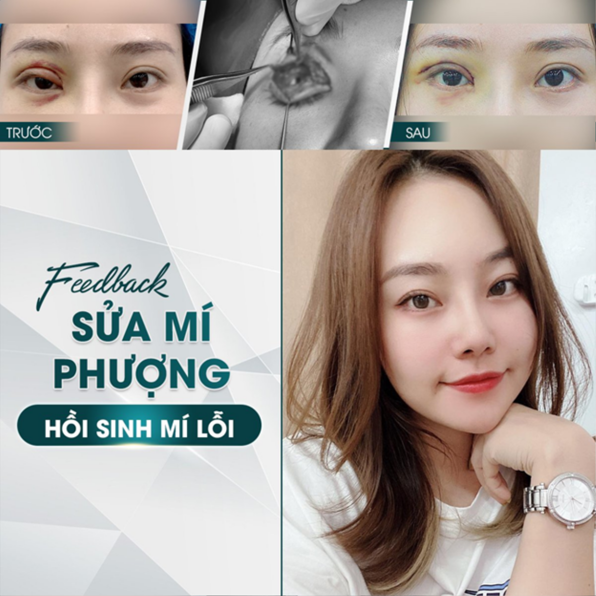 Hồi sinh đôi mắt biết cười với cô gái bị biến chứng hỏng 1 mắt phải sau cắt mí Ảnh 3