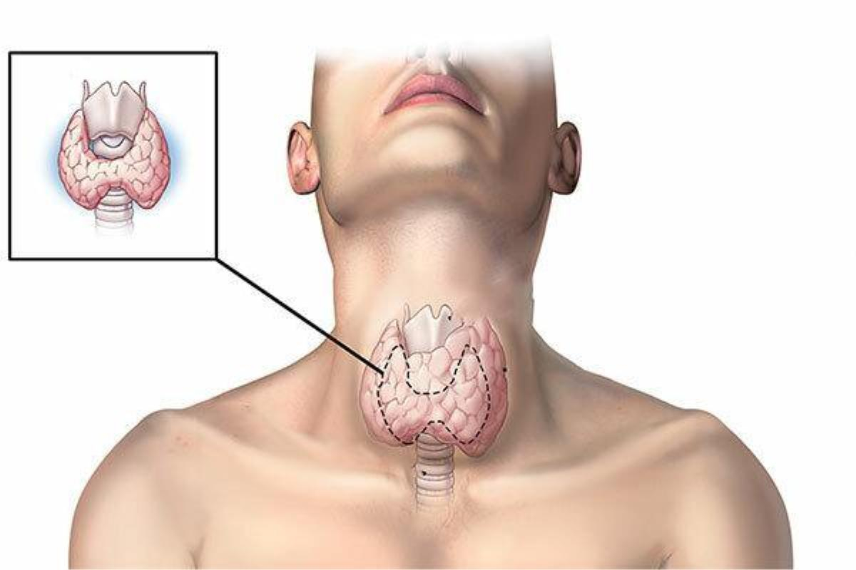 4 Lý do điều trị ung thư tuyến giáp bằng nọc bọ cạp xanh Cuba không phải ai cũng biết Ảnh 4