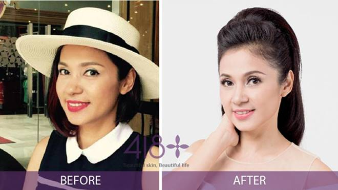Bùng nổ xu hướng làm đẹp 2017 - Trẻ hóa da tác động sâu không dao kéo Ảnh 2