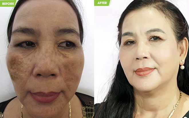 Giải cứu làn da của người phụ nữ ở Đồng Nai 20 năm nám cháy đen mặt Ảnh 2