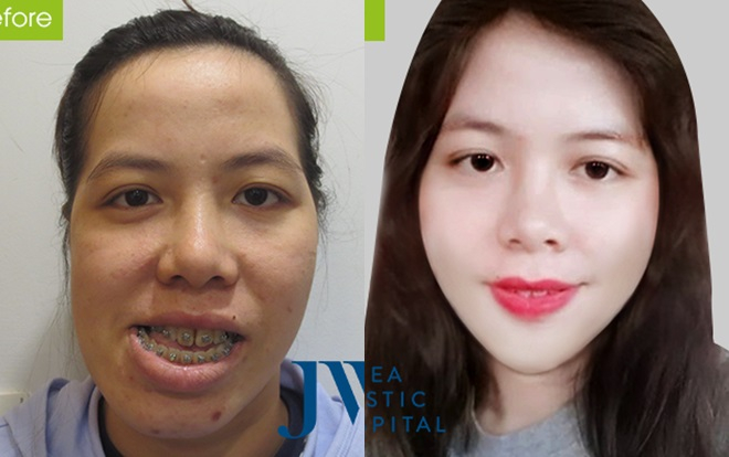 Phép màu giúp cô giáo Bình Định có gương mặt méo lột xác ngoạn mục sau phẫu thuật Ảnh 2