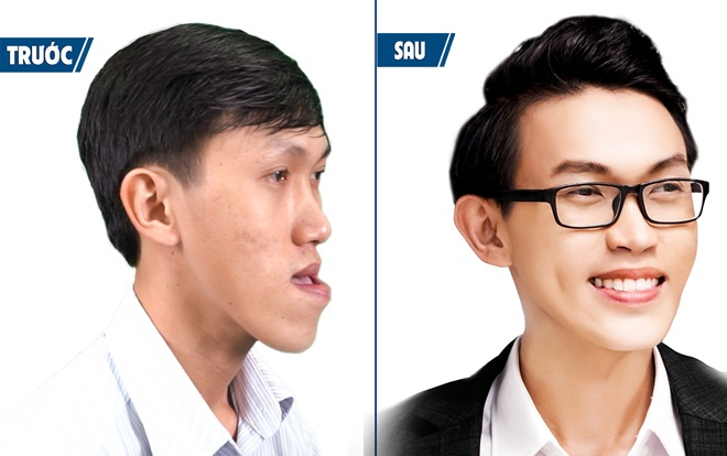 Thạc sĩ xe ôm liều mình cắt 2 hàm để trở thành người bình thường Ảnh 2