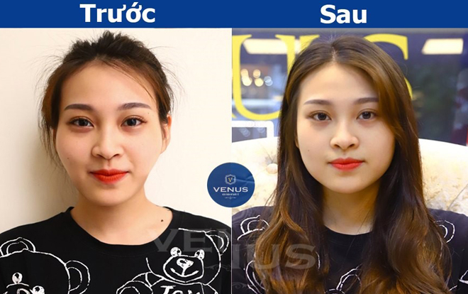 Tái sinh đa tầng, lưu giữ thanh xuân - giải pháp an toàn 'triệt tiêu' hoàn toàn má hóp, gò má cao của phái đẹp Ảnh 2