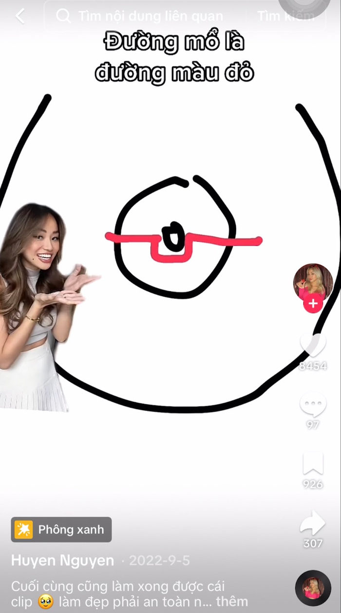 Huyền Nguyễn chia sẻ chi tiết về giá cả, kỹ thuật và đường mổ trong cuộc phẫu thuật của mình