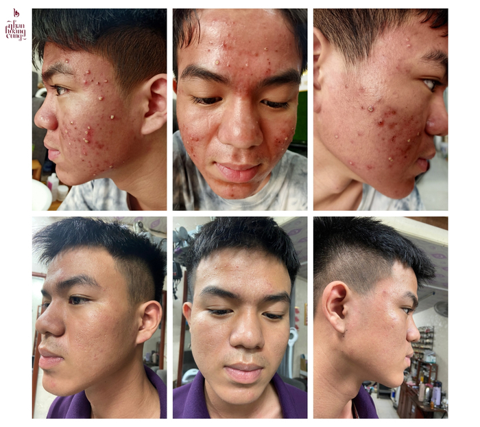 Mụn tuổi dậy thì gây ảnh hưởng đến tâm lý của các bạn trẻ, khiến các bạn cảm thấy tự ti về ngoại hình của mình