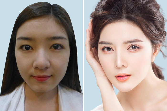 Ngoài nâng ngực nội soi, Lilly Luta còn cắt mí, nâng mũi, gọt góc hàm, nâng cằm tại bệnh viện thẩm mỹ Việt Mỹ.