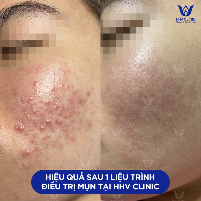 Kết quả sau 1 liệu trình điều trị tại Phòng khám da liễu HHV Clinic
