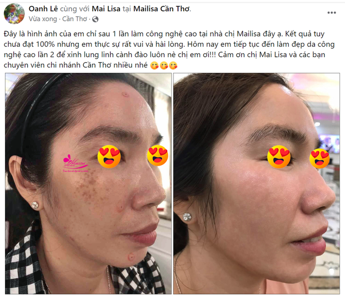 Dịch vụ điều trị da xấu bằng laser tại Mailisa Cần Thơ đã giúp nhiều chị em lấy lại làn da mịn màng, trắng sáng