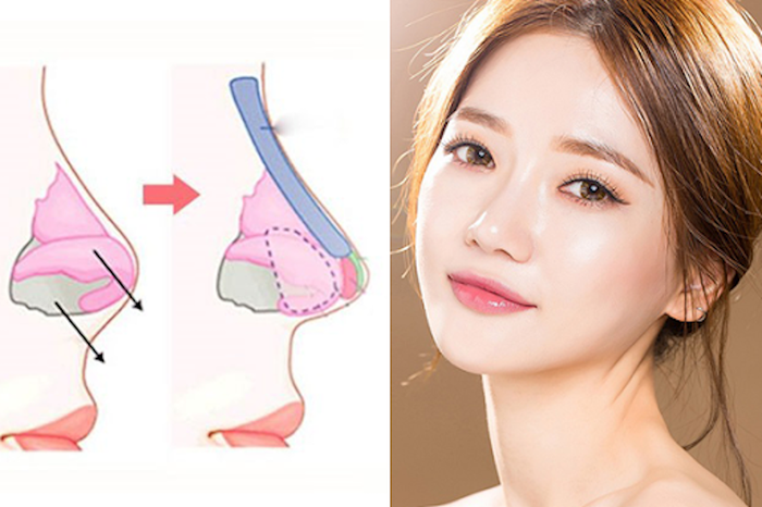  Nâng mũi S Line là gì? Có nên nâng mũi S Line không? Ảnh 2