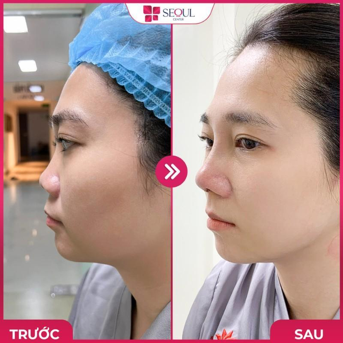  Nâng mũi S Line là gì? Có nên nâng mũi S Line không? Ảnh 5