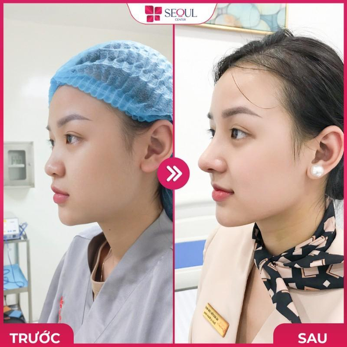  Nâng mũi S Line là gì? Có nên nâng mũi S Line không? Ảnh 4