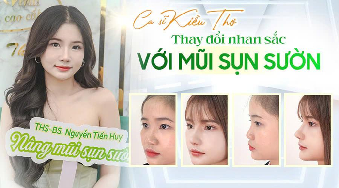 Ca sĩ Kiều Thơ: Thay đổi nhan sắc với mũi sụn sườn Ảnh 1