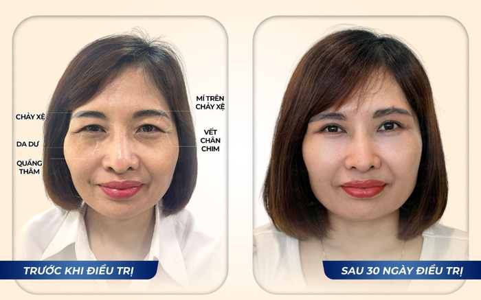 2 Bí kíp nhấn mí an toàn giúp bạn sở hữu nếp mí rõ đều tự nhiên Ảnh 2