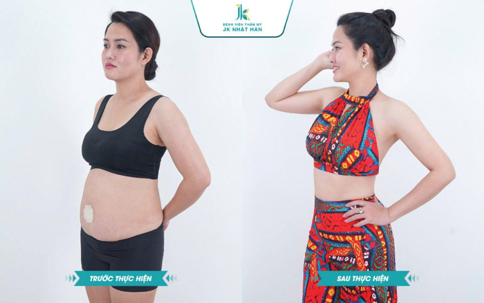 Sở hữu vòng eo thon gọn thật nhanh chóng và an toàn là lựa chọn của nhiều khách hàng tại JK Nhật Hàn