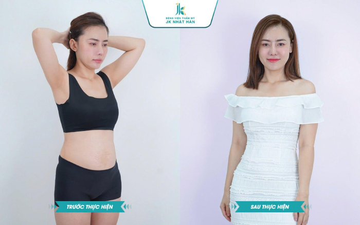 Tạo hình thành bụng nội soi Ommi không phẫu thuật cắt da giúp tín đồ thẩm mỹ hiện đại nhanh chóng hồi phục với kết quả tự nhiên và lâu dài.