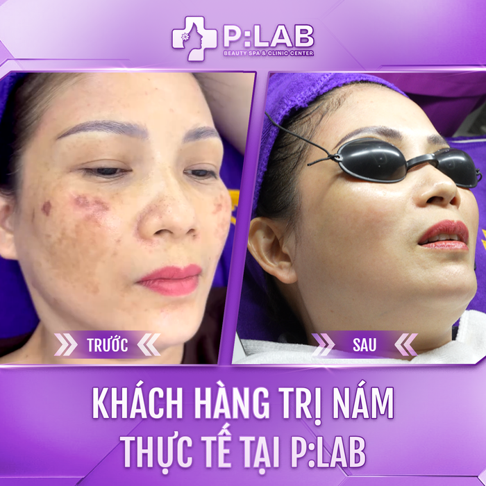 Bác Sĩ CKII Vũ Tuấn Anh Bậc Thầy Chữa Thảm Họa Nám Tại Việt Nam Ảnh 3