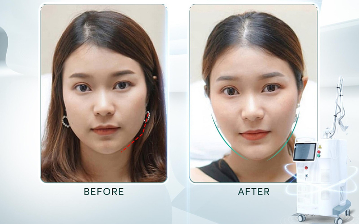 Dịch vụ Thon gọn hàm tại phòng khám Charlie có hiệu quả? Ảnh 2