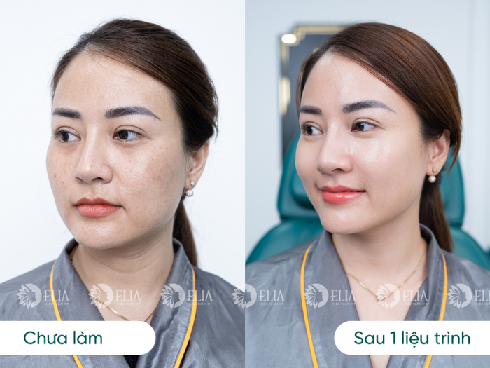 Kết quả da căng bóng mướt mịn sau 1 liệu trình cấy Meso Bio Young 