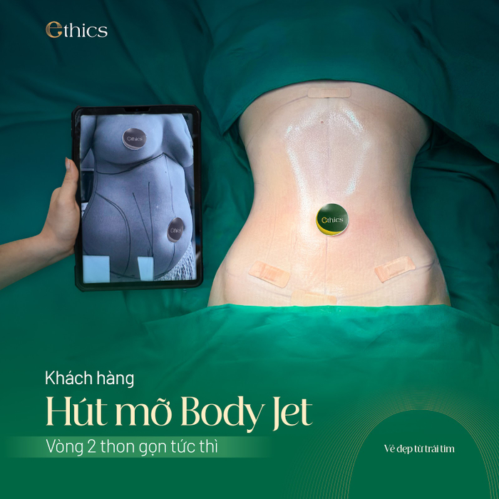 Vòng 2 thon gọn, không sưng tím hay sau Hút mỡ Body Jet