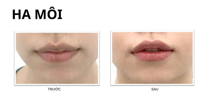 Sử dụng filler SARDENYA tạo môi sexy