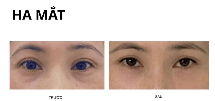 Sử dụng filler SARDENYA làm đẹp vùng mắt dưới
