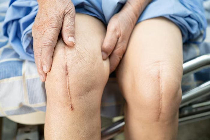 Tháo băng quá sớm dễ khiến vết thương nhiễm khuẩn, lâu lành và dễ để lại sẹo xấu