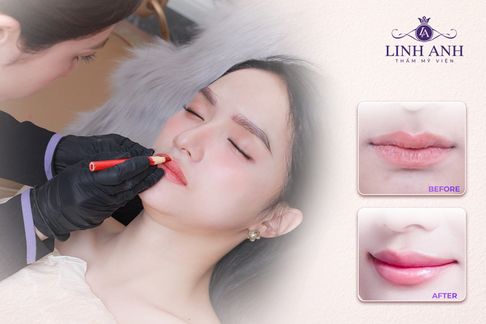 Phun môi chất lượng tại Thẩm mỹ viện Linh Anh