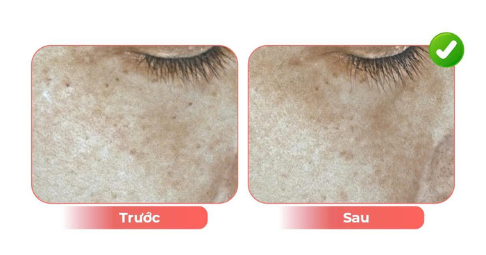 Lão hóa sắc tố là gì? Ảnh 2