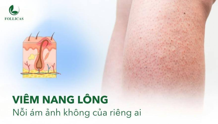 Viêm nang lông - vấn đề da liễu khiến nhiều người phải đau đầu