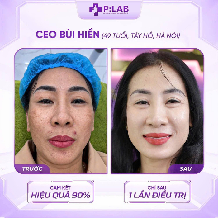 Chị Bùi Hiền, 49 tuổi, Tây Hồ, Hà Nội hạnh phúc khi lấy lại làn da sạch nám sau liệu trình trị nám tại P:LAB&nbsp;