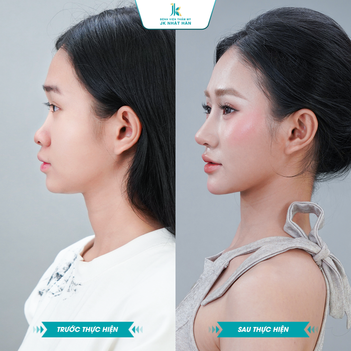 Dáng mũi khác biệt trước và sau khi thẩm mỹ của cô gái trẻ