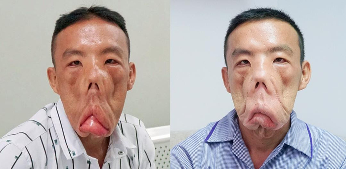 Mặt anh Mến sau 2 tuần điều trị bằng phác đồ đặc biệt đã gọn hẳn 4cm so với trước đây