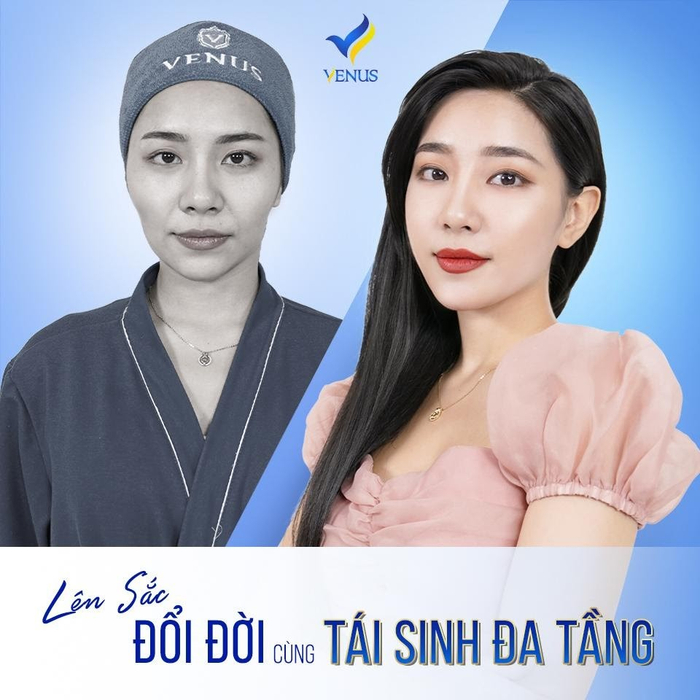 Chị Mai trẻ ra cả chục tuổi sau khi lấy lại khuôn mặt bầu bĩnh với bí quyết Tái sinh đa tầng