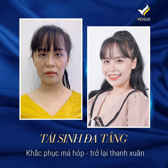 Chị Quyên (29 tuổi, Hà Nội) cũng thay đổi hoàn toàn khi tìm đến công nghệ Tái sinh đa tầng