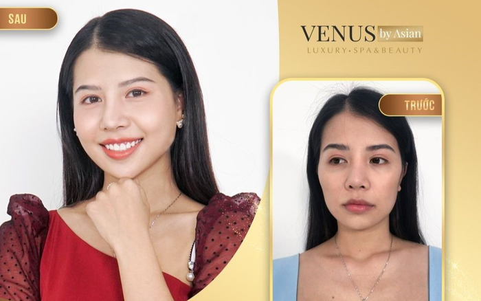 Hơn 10.000 chị em đã lột xác hoàn hảo sau khi thực hiện Tái sinh đa tầng tại Venus by Asian Ảnh 2