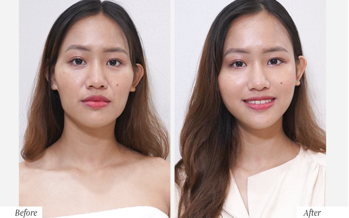 Khắc phục má hóp, gò má cao không cần phẫu thuật bằng Tái sinh đa tầng, lưu giữ thanh xuân Ảnh 2