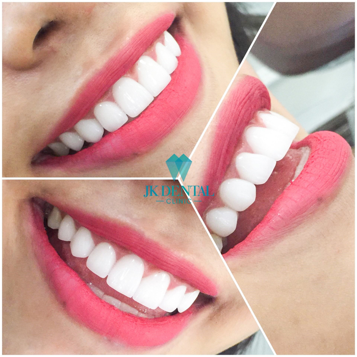 Khách hàng hài lòng với dịch vụ bọc răng sứ thẩm mỹ bởi độ chuẩn xác, làm tôn lên vẻ đẹp của gương mặt nhờ tính thẩm mỹ cao