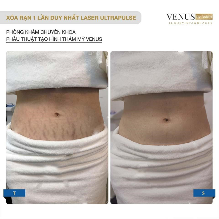 Kết quả sau khi sử dụng Laser Ultrapulse Plus tại Venus