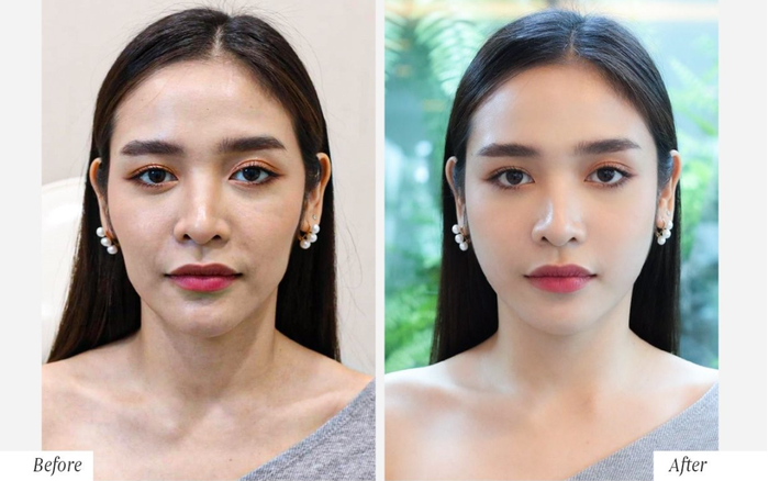 Khách hàng lặn lội từ Vĩnh Phúc lên Hà Nội tìm lại 10 năm tuổi xuân với Tái sinh đa tầng Ảnh 2