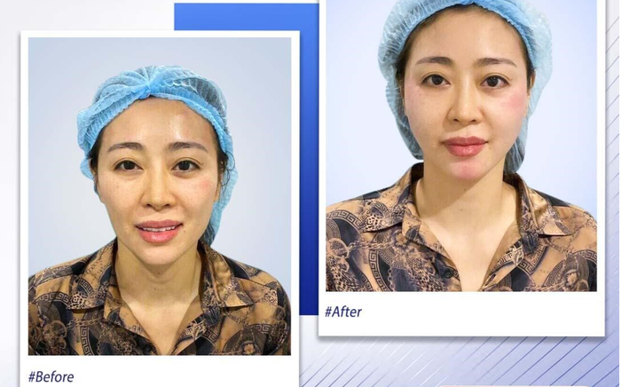 'Cải lão hoàn đồng' trẻ ra 10 tuổi nhờ phương pháp làm đẹp đa công nghệ hot nhất hiện nay Ảnh 2