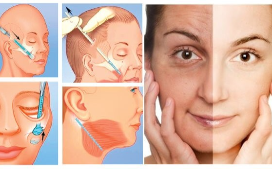 Top 3 phương pháp làm đẹp, trẻ hóa hàng đầu hiện nay Ảnh 2
