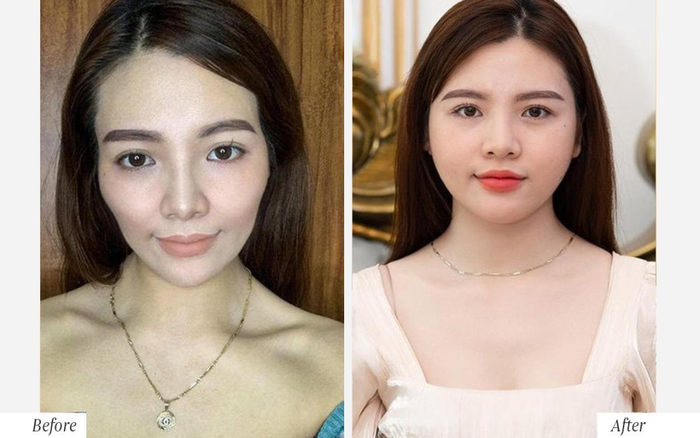 Tái sinh đa tầng công nghệ làm đẹp không xâm lấn đi đầu 2021 Ảnh 2