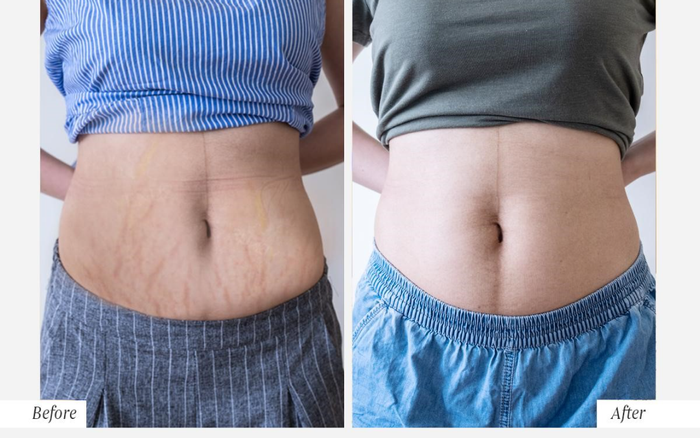 Vì sao công nghệ trị rạn Laser Ultrapulse Plus hot đến vậy? Ảnh 2