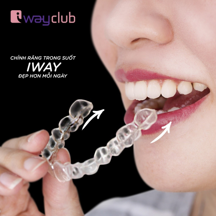Công nghệ niềng răng trong suốt tại iWay Club cho nụ cười luôn xinh tươi Ảnh 4