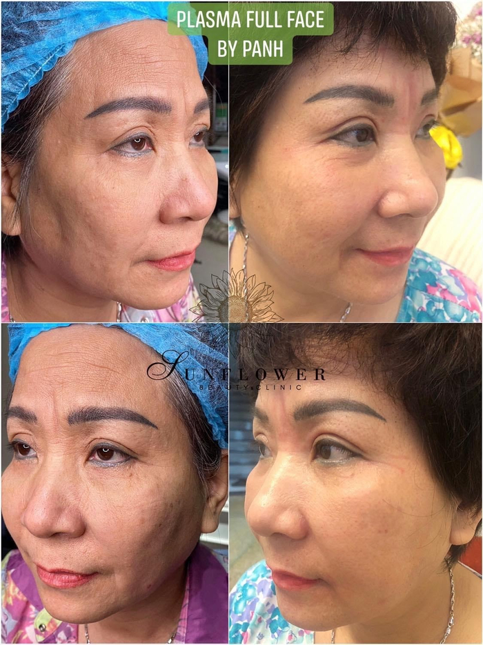 Hình ảnh một khách hàng đã điều trị phương pháp trẻ hóa làn da cùng công nghệ Plasma
